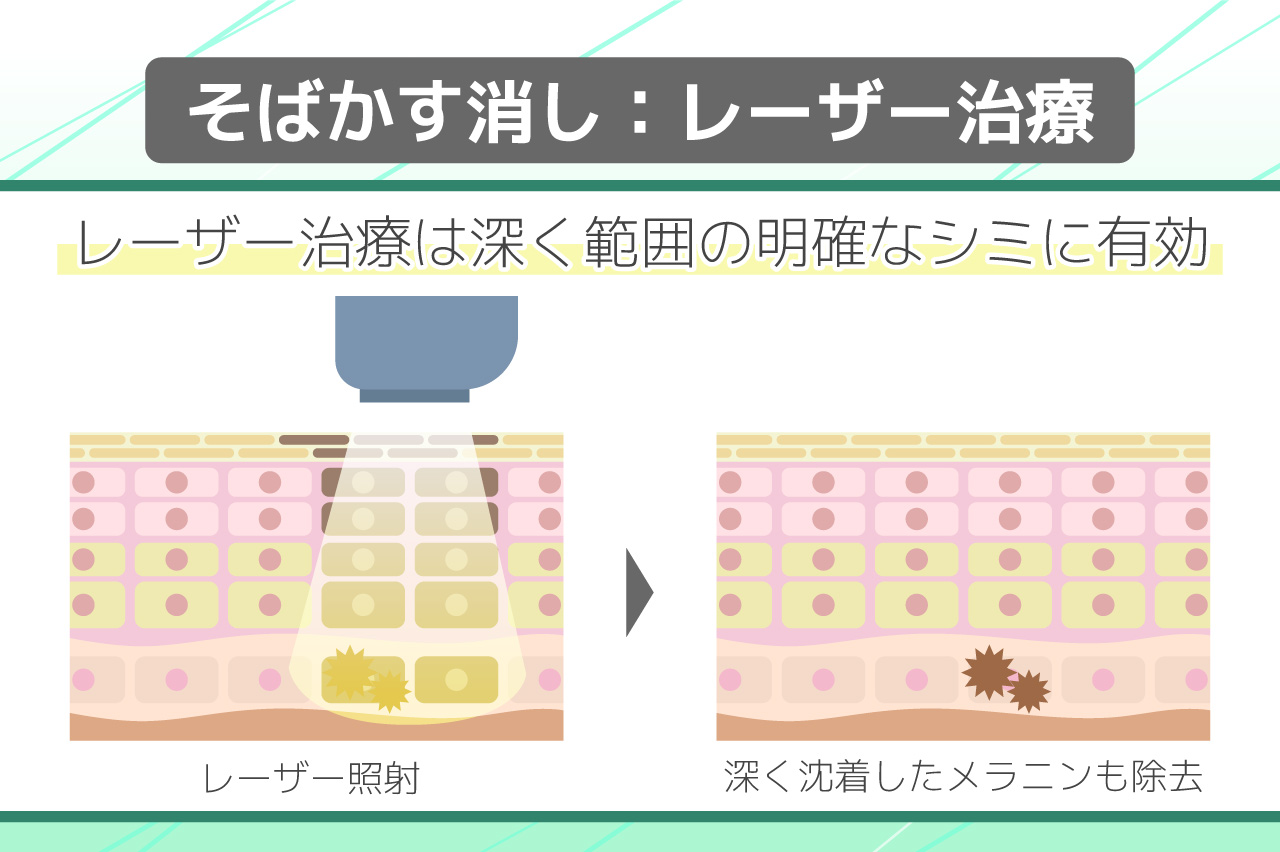 そばかすを消すレーザー治療の特徴